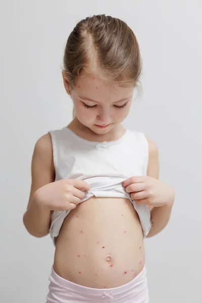 Criança Com Espinhas Varicela Olhando Para Estômago — Fotografia de Stock