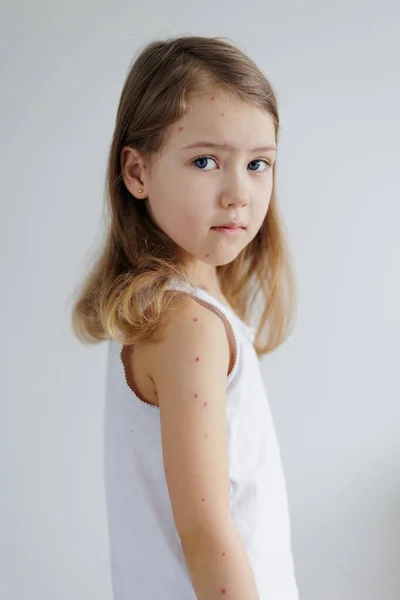 Portrait of sad child with pimples of chickenpox