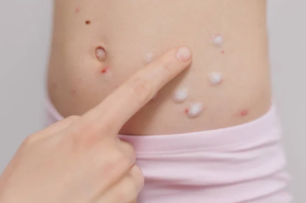 Child Stomach Infected Chickenpox Having Treatment Using White Antiseptic Foam — Stock Photo, Image