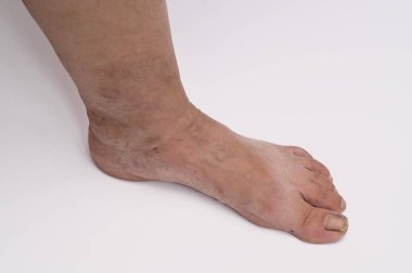 İnce şişkinlik ve görünür yüzey damarları olarak ilk damar bozukluğu belirtileri yetişkin alt uzuvlarda erken safhadaki venöz yetersizliği gösteriyor. Venöz reflü veya kronik venöz yetersizlik belirtileri.. 