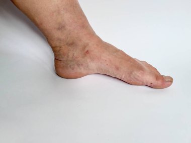 Cilt rengi bozulması, görünür damarlar ve hafif şişkinlik, deri altında kan birikintilerinin ve damarların büyüdüğü venöz yetersizliğin yaygın belirtilerini yansıtır. Damar zayıflığı ve bacaklarda varis. 