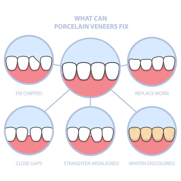 Δόντια Και Χαμόγελο Makeover Οδοντιατρική Κεραμικά Καπλαμάδες Σειρά Των Δοντιών — Διανυσματικό Αρχείο