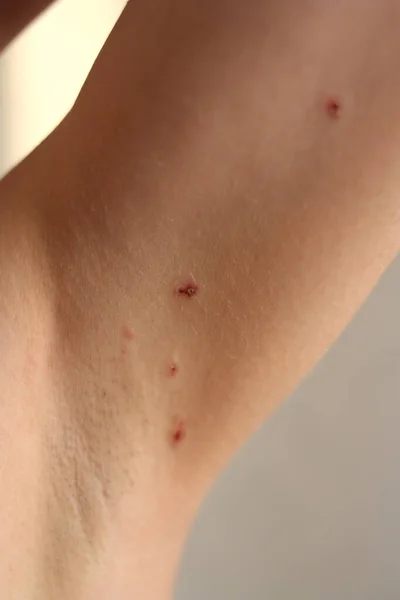 Skin on the armpits after removal of papillomas by laser