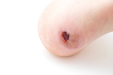 Big Bloody calluses scar on the human heel.