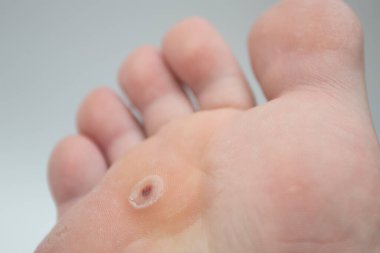 Ayak parmağı siğili. Ayağında siğil olan bir ayak. Siğil balığı plantarı.