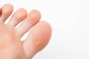Ayak başparmağında siğil var. HPV virüsü