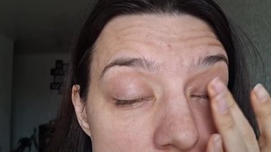 Konjonktivite bağlı şişmiş gözler.