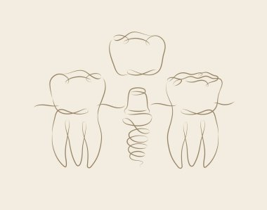 Bej arkaplanda doğrusal olarak diş implantı çizimi