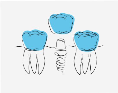 Beyaz ve mavi arkaplanda doğrusal olarak diş implantı çizimi