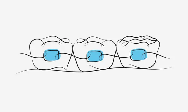 Beyaz Mavi Arkaplanda Diş Teli Çizimi Çizimi — Stok Vektör