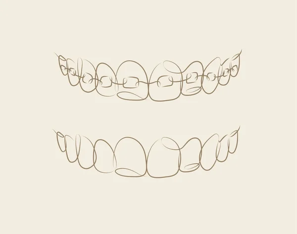 Jaws Braces Installed Drawing Linear Style Beige Background — Stock Vector