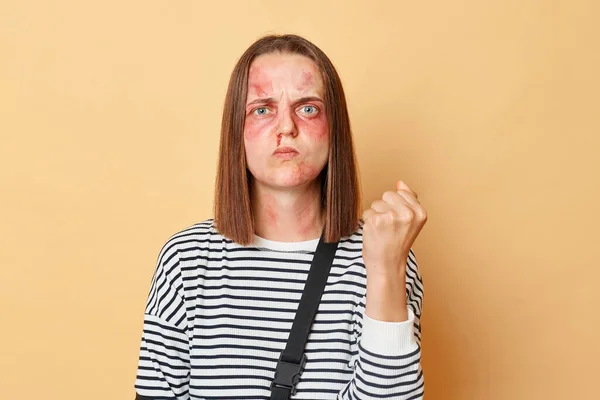 Angry Strict Woman Striped Shirt Bruised Skin Standing Isolated Beige — Stock Photo, Image
