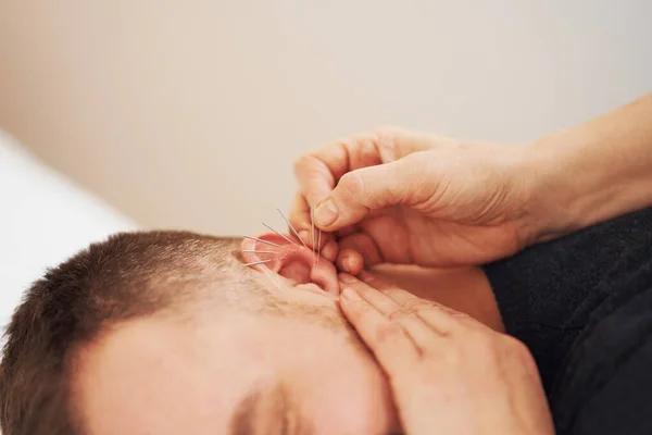 Picture Man Having Acupuncture Ear High Quality Photo — Stock Photo, Image
