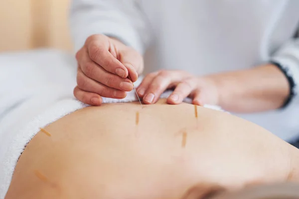 Stüdyoda Akupunktur Iğnesi Terapisi Yüksek Kalite Fotoğraf — Stok fotoğraf