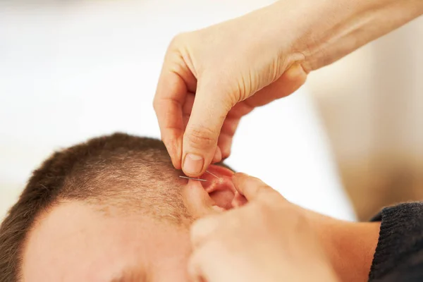 Ein Bild Von Einem Mann Mit Akupunktur Ohr Hochwertiges Foto — Stockfoto