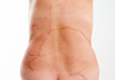 Denizanası Portekizli savaşçının yaktığı derisi yanmış kadın derisi resimleri. Yüksek kalite fotoğraf