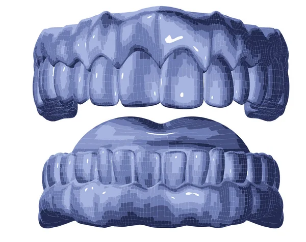 Abbildung Des Prothesennetzes Zahnschienen Und Aligner — Stockvektor
