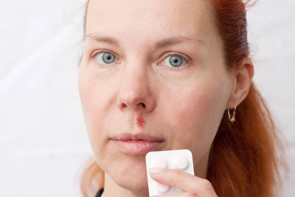 Portrait of middle aged woman with herpes above upper lip, on light background. woman holding pills in hand. Infectious inflammation of face and lips caused by HSV. Dermatology. Medicine.