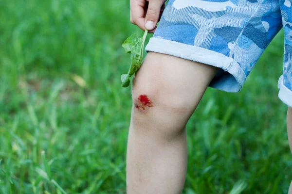 儿童膝部因跌倒而出现新的出血伤 童年的创伤 夏天户外儿童受伤 — 图库照片