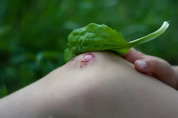 儿童膝部因跌倒而出现新的出血伤 小孩用植物叶来包扎伤口 孩子们在户外受伤 植物疗法 民间医药 — 图库照片