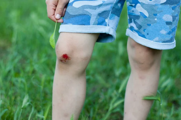 Closeup of fresh bleeding wound on child knee due to fall. Childhood trauma, pain, carelessness, accident. Childrens injuries in summer outdoors