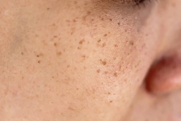 Woman\'s problematic skin pore and dark spots on the face