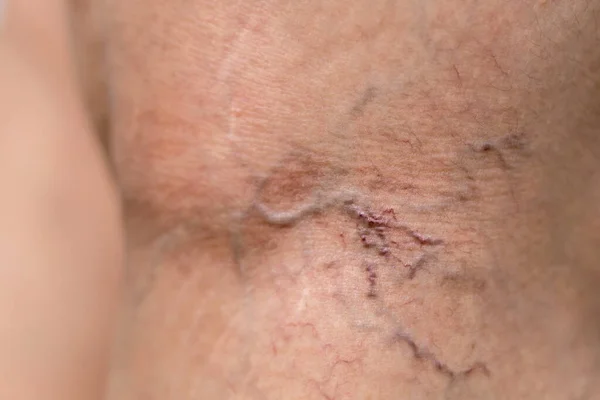 Painful varicose and spider veins on womans legs ,active life concept.