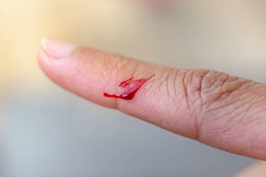 Bıçakla yaralanmış ve kanaması olan bir parmak..