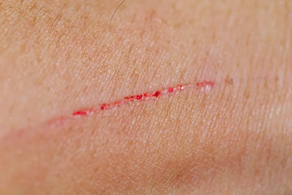 Wounds Scratches Cat Nails — Stock Photo, Image