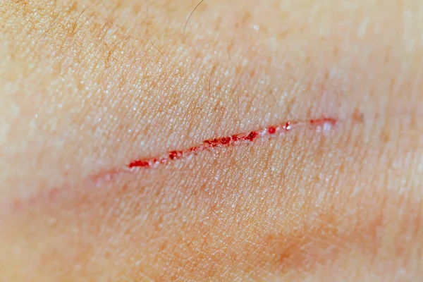 被猫的指甲划伤的伤痕 — 图库照片