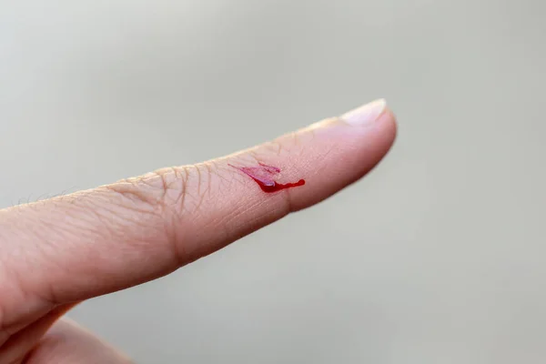 Finger Injured Knife Bleeding — Stock Photo, Image