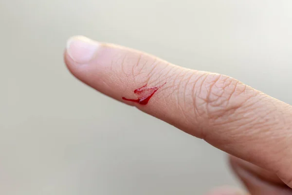Ett Finger Som Skadades Kniv Och Blödde — Stockfoto