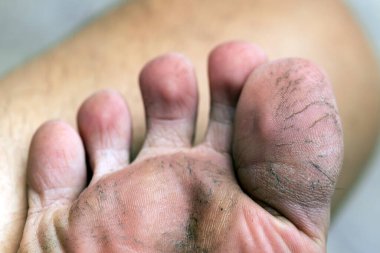 Bakım eksikliğinden topuklarda çatlaklar var.