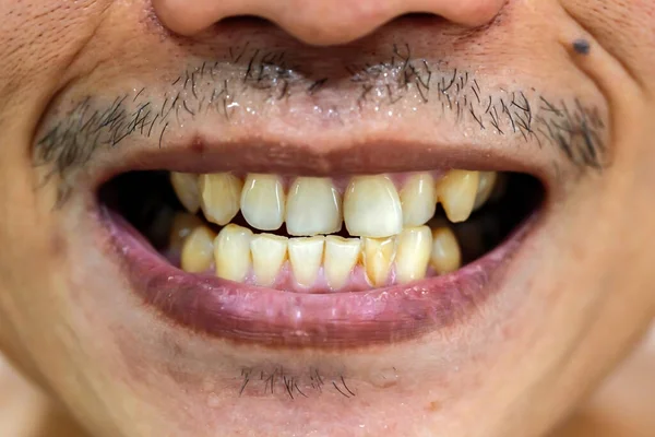 患者在预防治疗前 脏棕色牙齿 — 图库照片