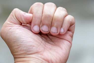 Tırnak tozuyla dolu kirli tırnaklar.