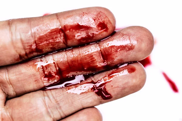 Κηλίδες Αίματος Στα Χέρια — Φωτογραφία Αρχείου