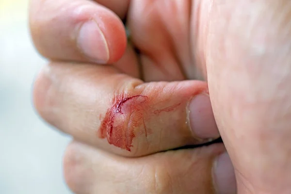 Blood Flowed Skin Due Abrasions — Stock Photo, Image