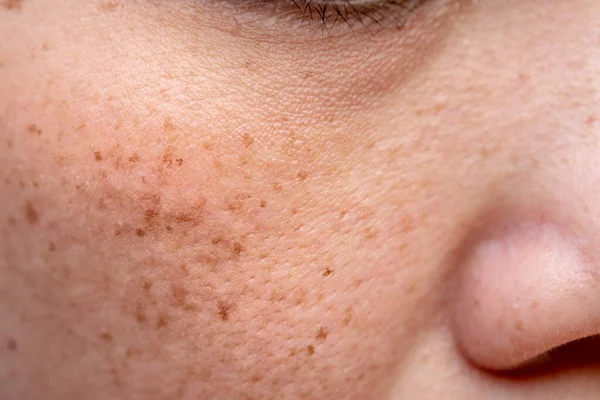 Woman\'s problematic skin pore and dark spots on the face