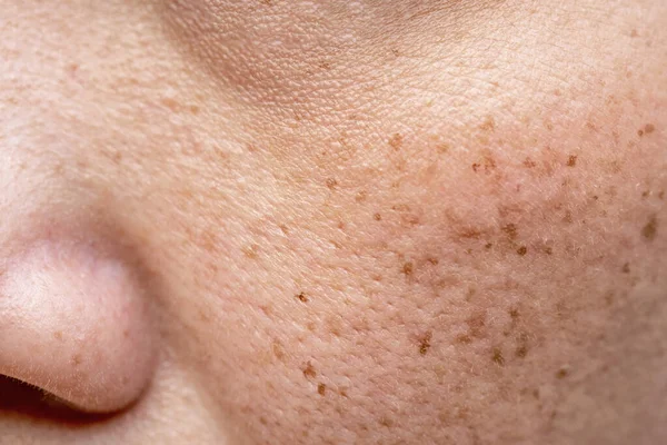 Woman Problematic Skin Pore Dark Spots Face — Stock Photo, Image