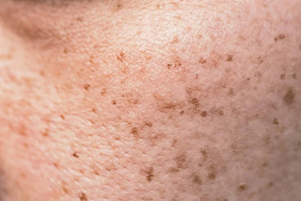 女性の問題の皮膚の毛穴や顔の暗いスポット — ストック写真
