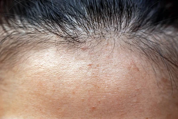 Forehead Woman Thin Hair — Stock Photo, Image