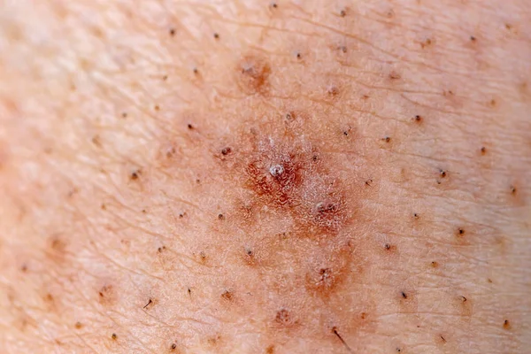 Closeup Caucasian Skin Ingrown Hair — Stock Photo, Image