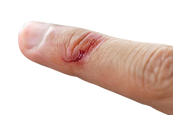 Blood Flowed Skin Due Abrasions — Stock Photo, Image