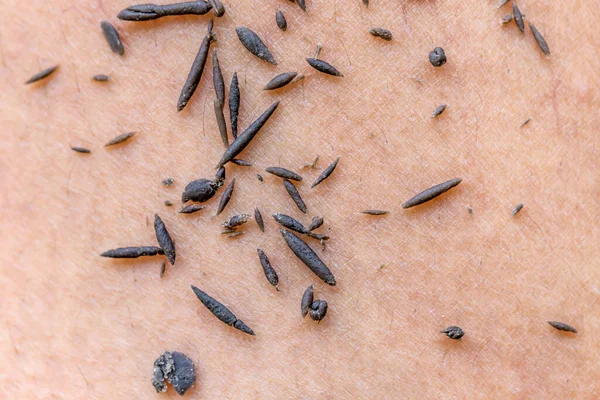 human skin with dry black seeds on the background of human skin.