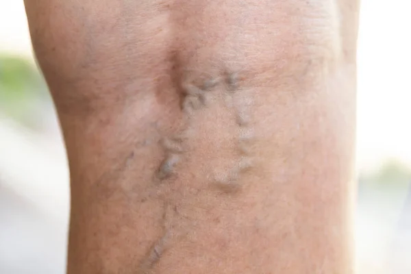 Frauenbein Auf Der Haut Nach Operationen Venen Knieoperationen lizenzfreie Stockfotos