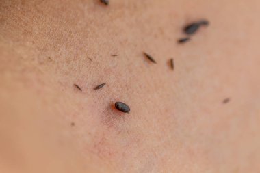 Siyah dermatoloğun dermatoloğu, derisi ve derisi, yakın plan. Deri, derit, derit, der