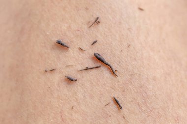 Beyaz arka planda insan derisinin arkasında siyah lekeler olan insan derisi.