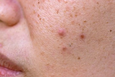 akne ve deriye yakın