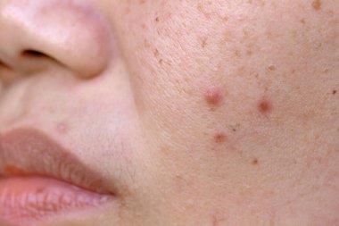 Cilt sorunu ve tedavi. Genç kadın yüzüne yakın dur..