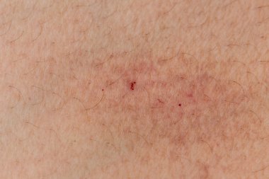 Deri iltihabı, iltihabı, iltihabı olan bir kırmızı..